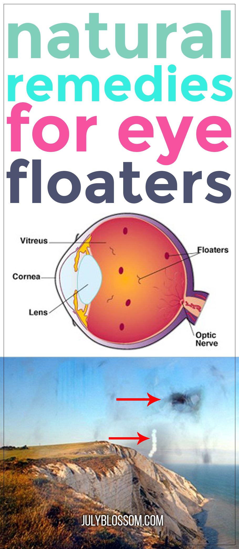 I see floaters all the time. They are super annoying and depressing. Sometimes I think there’s a mosquito buzzing around near me but then I realize it’s a pesky old floater. Do you struggle with the same issues? I feel you. That’s why in this article I share some natural remedies for eye floaters that may help you.